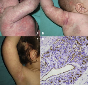 Hemangioma abortivo segmentario y nevus sebáceo en el cuero cabelludo. Lesión segmentaria contusiforme con áreas pálidas alrededor y en el interior de la lesión a las 48 horas de vida (A), finas telangiectasias sobre manchas rosadas con aspecto reticulado y algunas pápulas puntiformes a los 4 meses de edad (B), aclaramiento del hemangioma a los 2,5 años de edad (C). Expresión de GLUT-1 tanto por las células endoteliales tumefactas que revisten las luces de pequeño tamaño, como por las células endoteliales aplanadas de algún capilar dilatado, tinción con GLUT-1 x 200 (D).