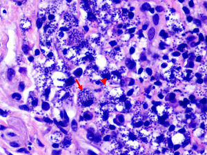 Extensos infiltrados inflamatorios de predominio linfocitario y frecuentes macrófagos con estructuras redondas-ovales basófilas tanto intracitoplasmáticas (flecha) como a su alrededor (punta de flecha), compatibles con amastigotes de Leishmania (hematoxilina-eosina x400).