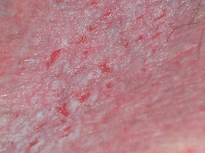 Dermatitis de contacto alérgica e irritativa en región vulvar. Impacto de  los jabones íntimos