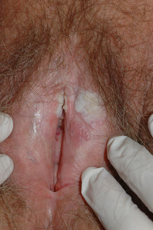 Placa verrugosa blanquecina en región vulvar izquierda correspondiente a un carcinoma verrugoso vulvar sobre un liquen escleroso.