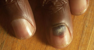 Se puede apreciar un hematoma subungueal localizado en la zona proximal de la uña de un dedo de la mano.