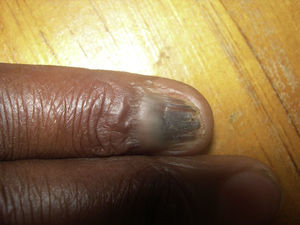 Pterigium y atrofia de la lámina ungueal.