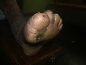 En la punta de los dedos de los pies aparecen varias úlceras características del mal perforante de la lepra.