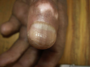 Obsérvese las bandas pigmentadas que se extienden longitudinalmente desde la lúnula al borde libre del lecho ungueal o melanoniquia longitudinal.