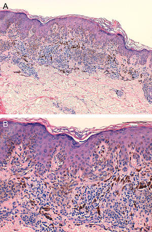 A. Proliferación de melanocitos en la unión dermoepidérmica y dermis (H-E x40). B. Formación de nidos con tendencia a la fusión y disposición paralela a la superficie cutánea con focal atipia citológica (H-E x200).