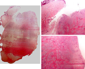 Izquierda: macromicrofotografía (imágenes de H-E x2 ensambladas con Photomerge®): epidermis y dermis normal. Lesión nodular subcutánea compuesta de granulomas sarcoideos y acompañada por fibroplasia perigranulomatosa. Derecha: H-E x2: imágenes representativas de la zona de aspecto nodular.