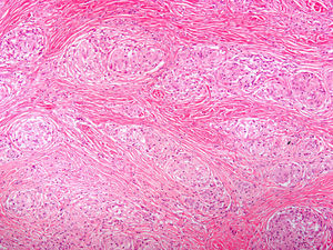 H-E x10. Detalle de la lesión. Granulomas bien definidos que predominan sobre la llamativa fibroplasia que los rodea.