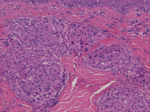Presencia de granulomas epitelioides en la dermis de la biopsia cutánea de la espalda (H-E x200).