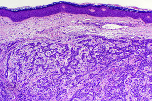 Proliferación de células neoplásicas a nivel de la dermis que se disponen formando trabéculas, alvéolos y adoptando en algunas zonas un patrón pseudoglandular (hematoxilina-eosina, x100).