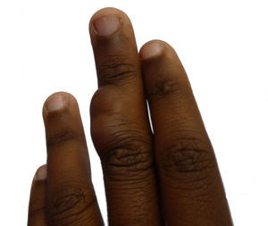 Aspecto clínico de la lesión. Se identifica un nódulo de color piel de 2,5cm de diámetro en la falange media del 3° dedo de mano izquierda.