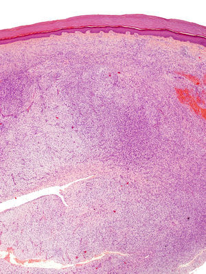 Imagen panorámica donde se observa una neoformación fusocelular que ocupa difusamente la dermis reticular y parte del tejido celular subcutáneo (HE 40X).