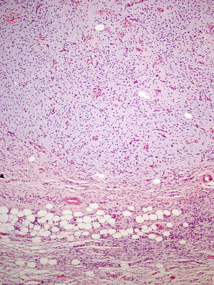 La lesión presenta áreas extensas mixoides, así como infiltración «en panal de abeja» del tejido celular subcutáneo (HE 100X).