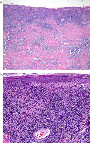 a. Biopsia cutánea con infiltrado pandérmico tumoral con epidermotropismo. HE x 40. 2 b. Detalle de la anterior HE x 200.