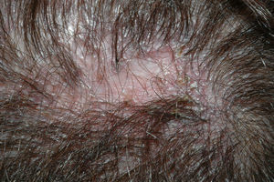 Liquen plano pilar. Foto de detalle. Hiperqueratosis folicular y cicatriz atrófica central.