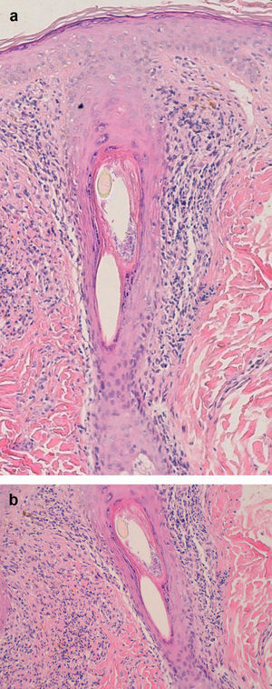 a) Liquen plano pilar. Denso infiltrado linfocitario perifolicular (hematoxilina y eosina; x 100). b) Detalle de la figura anterior. Dermatitis de interfase (hematoxilina y eosina; x 200).