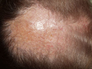 Alopecia cicatricial centrífuga central. Placa cicatricial de unos 15cm de diámetro en región interparietal. Actividad mínima en el borde con hiperqueratosis folicular.