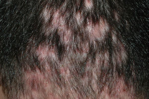 Foliculitis decalvante. Múltiples áreas de atrofia cicatricial de 0,5cm en las zonas donde previamente habían pústulas foliculares.
