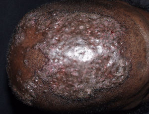Foliculitis disecante. Placa cicatricial en la zona interparietal en fase de remisión. El paciente había presentado previamente múltiples nódulos supurativos y fístulas.