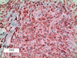 Imagen del CD3 positivo en las células grandes de una papulosis linfomatoide tipo A (CD3 ×30).