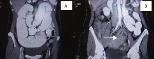 Tomografía computarizada. A. Dilatación retrógrada de intestino delgado compatible con obstrucción intestinal. B. Yeyuno. Imagen en anillos concéntricos múltiples con lesión central (imagen «en diana»).