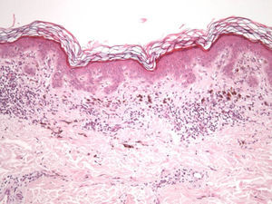 Elementos histopatológicos característicos de la regresión de nevos melanocíticos: epidermis no atrófica y presencia de infiltrado inflamatorio linfocitario, melanófagos, proliferación vascular y fibrosis dérmica. Hematoxilina-eosina, x 100.