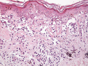 Fibrosis de tipo laminar predominantemente localizada en la dermis papilar. Hematoxilina-eosina, x 200.