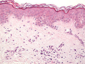 Fibrosis constituida por haces extraordinariamente finos de colágeno en la dermis papilar, con componente subepidérmico. También se observa una discreta proliferación vascular subyacente. Hematoxilina-eosina, x 200.