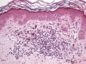 Infiltrado inflamatorio constituido mayoritariamente por linfocitos. Hematoxilina-eosina, x 200.