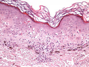 La epidermis muestra múltiples melanocitos y queratinocitos en apoptosis. Hematoxilina-eosina, x 200.