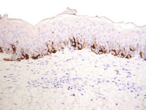 Una hiperplasia melanocítica lentiginosa residual se detecta en una minoría de casos. Melan-A, x 200.