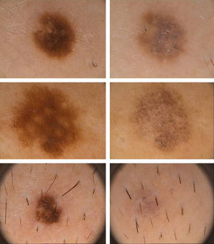 La principal característica dermatoscópica que se asoció a la regresión muy rápida de los nevos melanocíticos fue la presencia de una intensa melanofagia, junto a la desaparición del patrón estructural dermatoscópico previo.