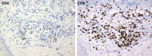 El infiltrado inflamatorio mostró un claro predominio de linfocitos T CD8+ respecto a los CD4+. Inmunoperoxidasa, x 400.