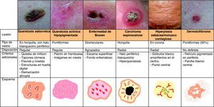 Resumen del patrón vascular de los tumores queratinizantes, hiperplasia sebácea/molusco contagioso y dermatofibroma.