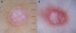 Vasos en corona presentes en dos lesiones de molluscum contagiosum.