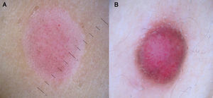 A. Nevus de Spitz con vasos puntiformes regulares distribuidos por toda la lesión.B. Nevus de Spitz con mayor polimorfismo vascular sobre la base rosada típica de dichas lesiones.
