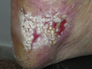 Placa ulcerada en talón del pie derecho con fondo de tejido de granulación y áreas de epitelio blanquecino y macerado.
