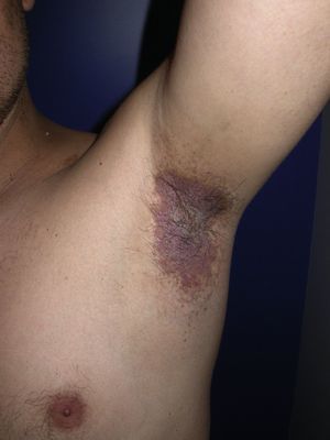 Placas eritematovioláceas y erosiones axilares en paciente con enfermedad de Hailey-Hailey antes del tratamiento con toxina botulínica.