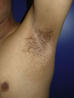 Resolución de la clínica cutánea después de la infiltración con toxina botulínica.