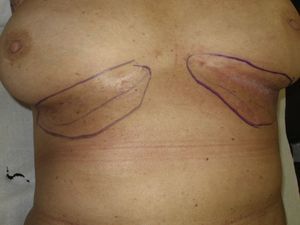 Placas eritematovioláceas y erosiones en pliegues inframamarios. Se muestra la delimitación de la zona a tratar incluyendo zonas afectas y zonas susceptibles de estarlo.