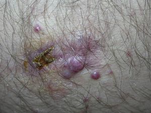 Granulomas piogénicos de diferente tamaño, uno de ellos biopsiado, alrededor de la cicatriz de la lesión primaria en muslo.