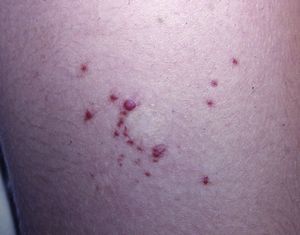 Pápulas de aspecto vascular en la periferia de la cicatriz de afeitado del granuloma piogénico primario.