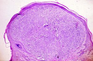 Proliferación lobular de capilares con collarete epidérmico en la periferia (hematoxilina-eosina, X40).