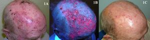 Múltiples queratosis actínicas tratadas con terapia fotodinámica con metilaminolevulinato. A. Previo al tratamiento. B. Emisión de fluorescencia. C. Resultado tras una sesión de terapia fotodinámica.