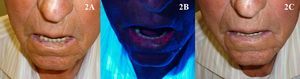 Queilitis actínica tratada con terapia fotodinámica con metilaminolevulinato. A. Previo al tratamiento. B. Emisión de fluorescencia. C. Resultado tras una sesión de terapia fotodinámica.
