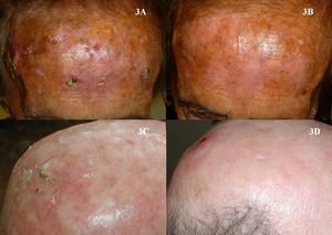 Múltiples queratosis actínicas tratadas con imiquimod. A. Antes del tratamiento. B. Tres meses tras finalizar el tratamiento. C. Antes del tratamiento. D. Tres meses tras finalizar el tratamiento.