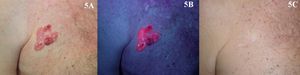 Enfermedad de Bowen tratada con terapia fotodinámica con metilaminolevulinato. A. Previo al tratamiento. B. Emisión de fluorescencia. C. Resultado tras tres sesiones de terapia fotodinámica.