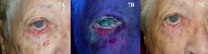 Carcinoma basocelular nodular y ulcerado en el párpado inferior del ojo derecho tratado con terapia fotodinámica con metilaminolevulinato. A. Previo al tratamiento. B. Emisión de fluorescencia. C. Resultado tras tres sesiones de terapia fotodinámica.