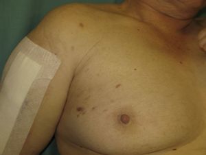 Imagen clínica de lesiones eritemato-violáceas en los cuadrantes externos de mama derecha.