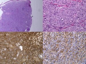 Imagen superior izquierda, tinción con hematoxilina-eosina 4x; imagen superior derecha, tinción con hematoxilina-eosina 20x; imagen inferior izquierda, CD34 10x; inferior derecha, CD31 20x.