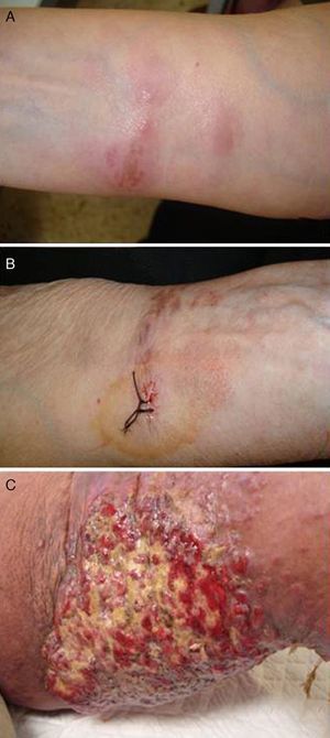 A: Aspecto inicial de la lesión en la cara flexora del antebrazo. Placa eritematosa-violácea mal delimitada, de tacto blando y depresible. B: Lesión del antebrazo en el momento de la cuarta recidiva, hace 3 años. Placa marrón-eritematosa de bordes mal definidos y tacto indurado. C: Lesión del muslo derecho en la última recidiva, hace 6 meses. Tumoración multinodular de superficie ulcerada y aspecto carnoso.